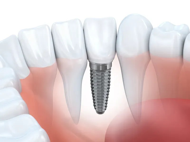 dental implant clinic in Noida