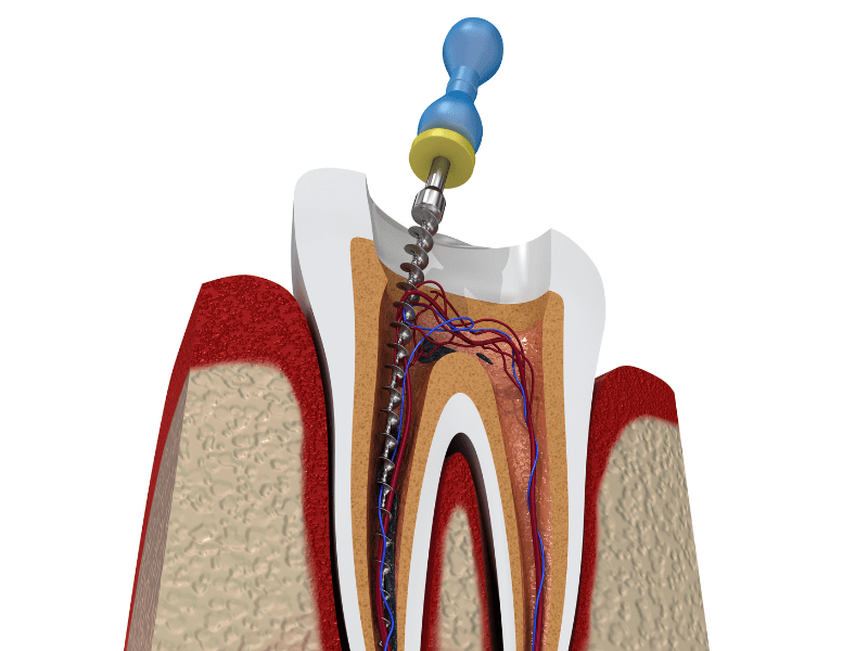 Common Myths and Misconceptions about Root Canal&nbsp;Treatment