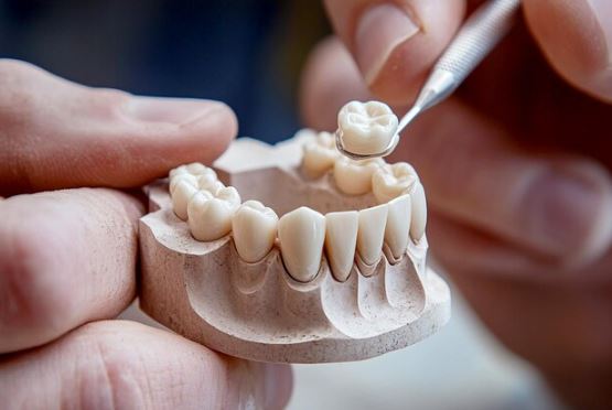 Get a Beautiful, Strong Smile with Dental Crowns and Bridges in Noida at Noida Dental&nbsp;Solutions