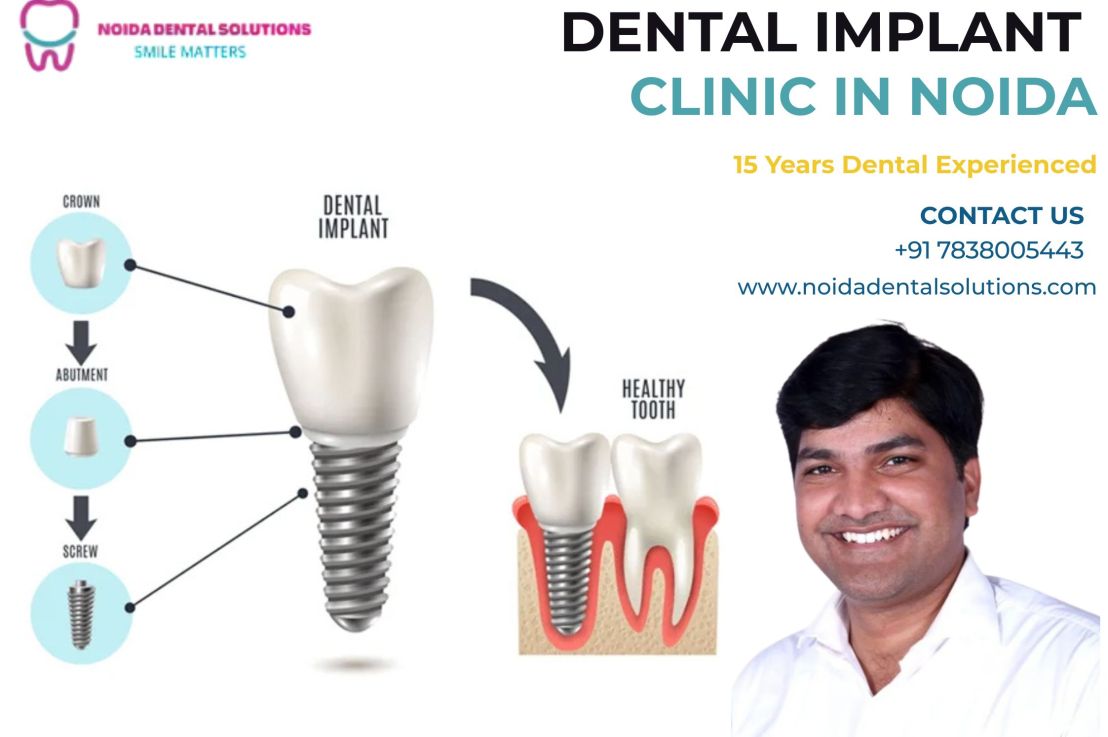 Transform Your Smile Dental Implant Solutions with Dr. Balram Nagar in&nbsp;Noida