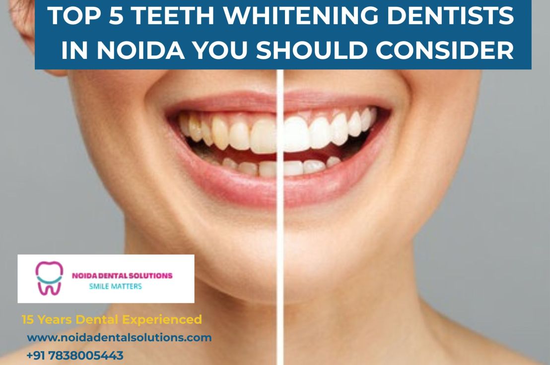 Top 5 Teeth Whitening Dentists in Noida You Should&nbsp;Consider